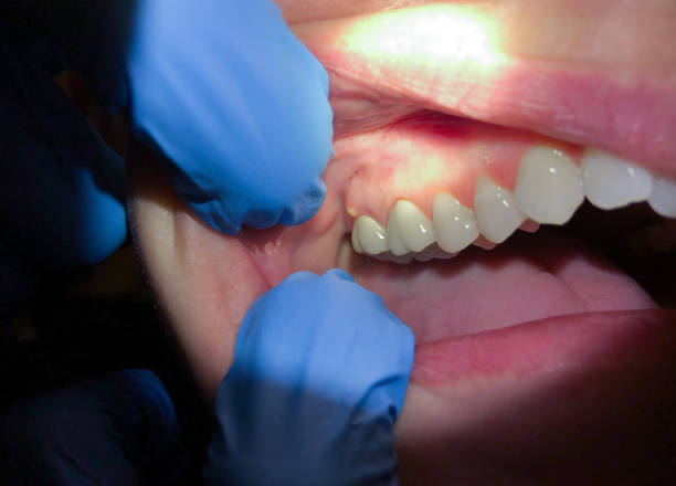 Best Emergency Wisdom Teeth Removal in Long Branch, VA