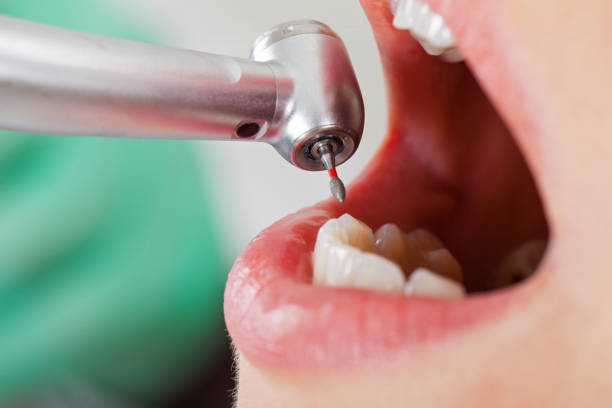 Best Emergency Treatment for Dental Infections or Abscesses in Long Branch, VA